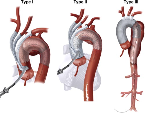 Diagram of Type I, II, and III aortic arch repair using hybrid and endovascular techniques. Dr. Jai Bhagwan Dhull specializes in advanced aortic aneurysm and dissection treatments.