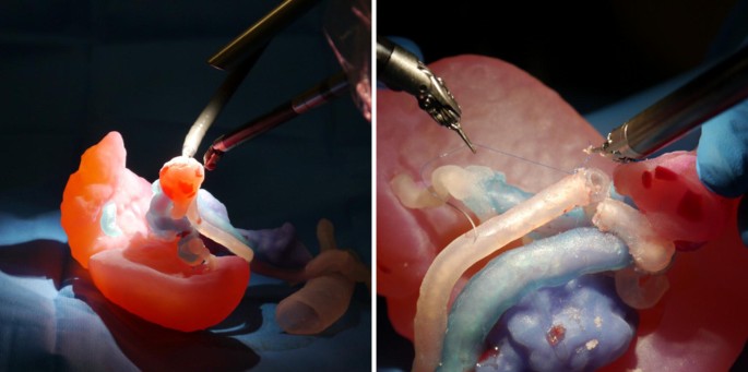 3D- printed heart model used for surgical simulation in minimally invasive cardiac surgery, demonstrating advanced cardiothoracic traning techniques by expert Dr. Jai Bhagwan Dhull.