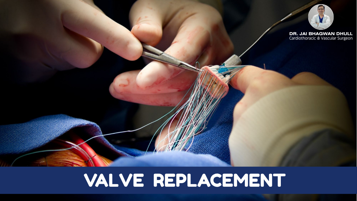Heart Valve Replacement Surgery | Procedure & Recovery