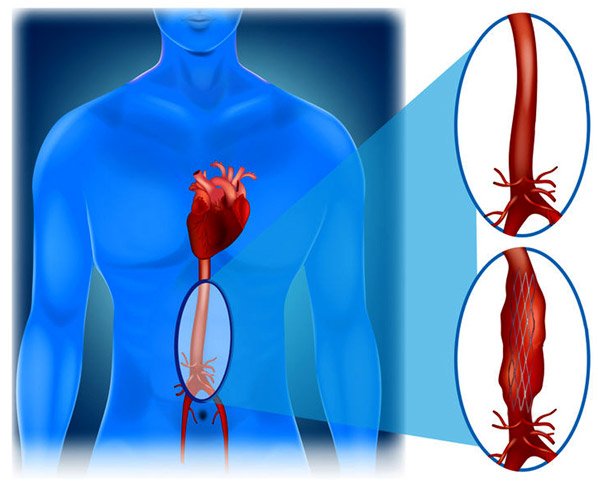 Medical illustration showing aortic aneurysms before and after stent graft repair, highlighting vascular intervention techniques used by Dr. Jai Bhagwan Dhull