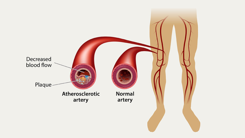 Illustration of an aortic aneurysm and stent graft placement inside the abdominal aorta, representing advanced vascular treatments performed by Dr. Jai Bhagwan Dhull.