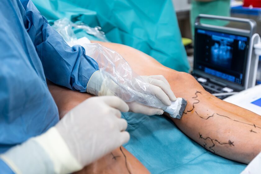 Minimally Invasive varicose vein treatment guided by ultrasound performed by Dr. Jai Bhagwan Dhull , expert cardiothoracic and vascular surgeon.