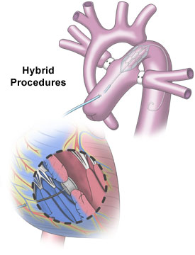 Illustration of hybrid cardiac procedures combining surgery and catheter techniques, as performed by Dr. Jai Bhagwan Dhull, expert cardiothoracic and vascular surgeon.