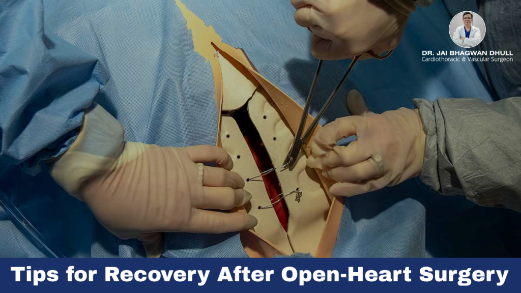 Surgeons performing open-heart surgery with recovery tips guidance by Dr. Jai Bhagwan Dhull, Cardiothoracic & Vascular Surgeon.