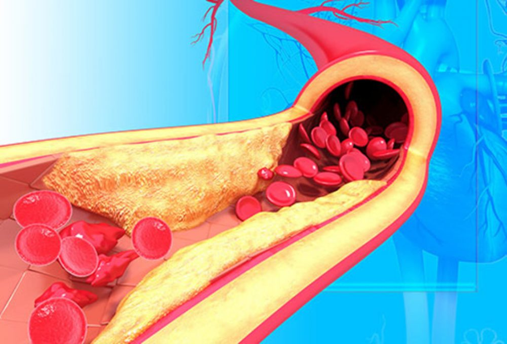 Illustration of artery blockage with plaque buildup and restricted blood flow, explaining how atherosclerosis leads to heart disease | Dr. Jai Bhagwan Dhull