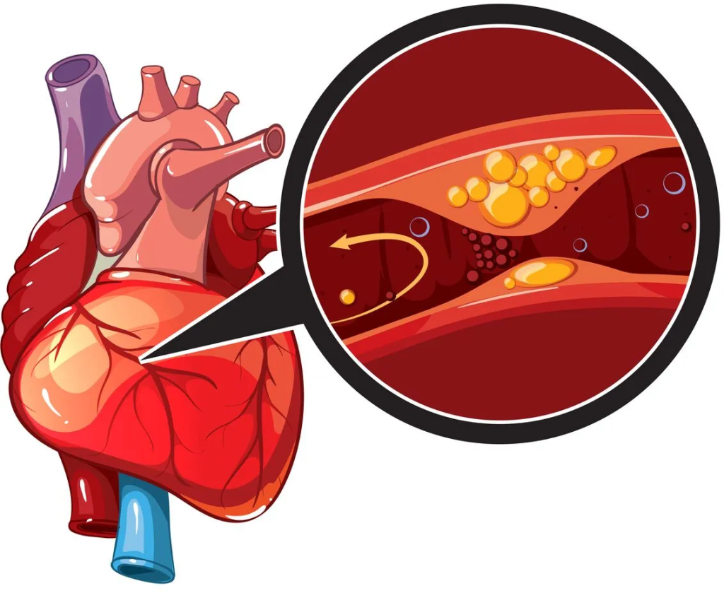 Illustration of human heart with magnified view of cholesterol plaque buildup in artery causing blockage and restricted blood flow | Dr. Jai Bhagwan Dhull